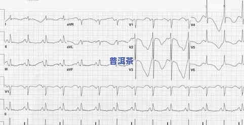 心律失常能喝茶叶吗-心律失常能喝茶叶吗女性