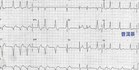心律失常能喝茶叶吗-心律失常能喝茶叶吗女性