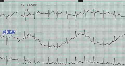 心律失常能喝茶叶吗-心律失常能喝茶叶吗女性