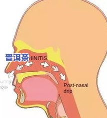 嗓子有痰能否喝茶？影响因素解析