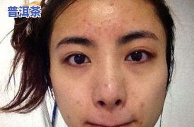 普洱茶脸上长痘痘能喝吗-普洱茶脸上长痘痘能喝吗女生