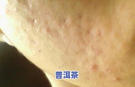 茶叶水擦痘痘真的有效吗？女生、客户都在问！