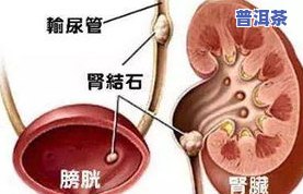 全面解析：茶叶对肾脏的影响及其实质