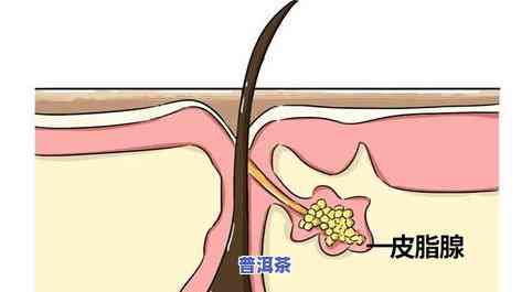 茶叶水可以洗痔疮吗？有效果吗？女生适用吗？看图熟悉治疗方法！