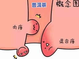 痔疮出血能喝茶叶吗？女性患者需要注意什么？