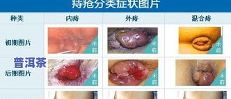 痔疮出血：可以喝茶叶吗？女/生适用，作用解析