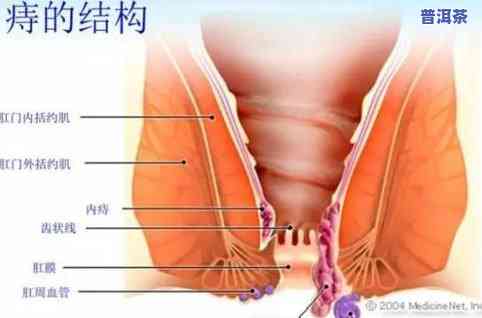 痔疮出血能喝茶叶吗-痔疮出血能喝茶叶吗女性