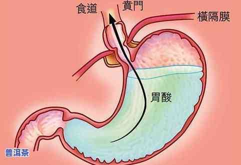 普洱茶喝完喉咙溃疡怎么办？喝完后喉咙痛、痒或不适的解决方法