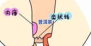 术后可以喝茶叶茶吗？包括痔疮、甲状腺手术在内的女性也适用