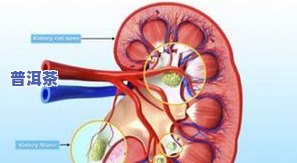 肾结石能喝茶叶吗？为什么会疼？详解影响与原因
