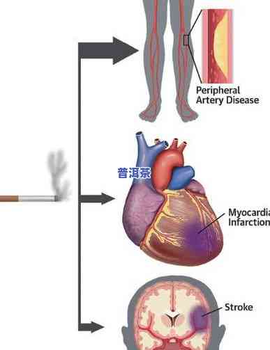 普洱茶扩张血管：有效改善心血管健康？