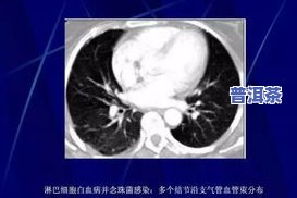 茶叶白化：定义、图片、期别与症状全解析