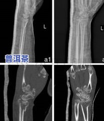 骨折喝茶叶好吗？效果、影响全面解析