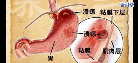 喝茶叶能中和胃酸吗？原因解析