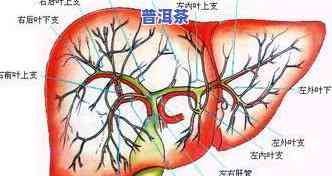 肝内胆管结石喝什么茶好？专家推荐有效饮品