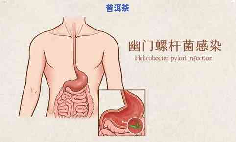 喝普洱茶会加重胃病吗？探讨其对胃部健康的影响及原因