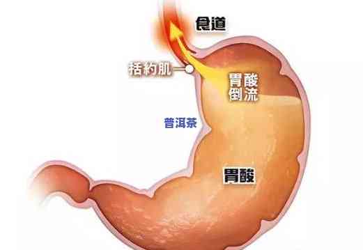 普洱茶会不会伤胃？探讨其对胃部的影响及可能的危害