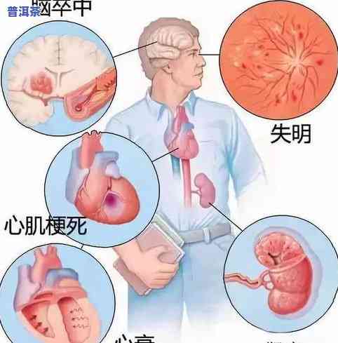 血压高能否饮用茶叶？影响因素及建议