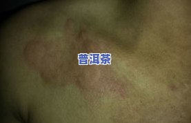 喝普洱茶皮肤过敏症状：全身痒、红肿等怎么办？