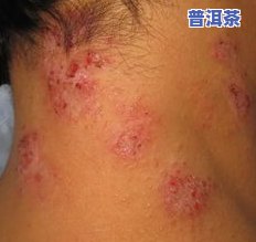 喝普洱茶皮肤过敏症状：全身痒、红肿等怎么办？