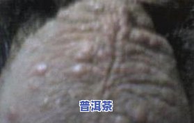 喝普洱茶皮肤过敏症状：全身痒、红肿等怎么办？