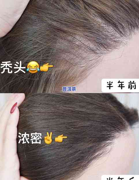 脱发喝茶叶有作用吗？女生该留意什么？