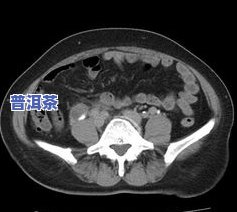 肾结石茶叶可以喝吗-肾结石茶叶可以喝吗女性