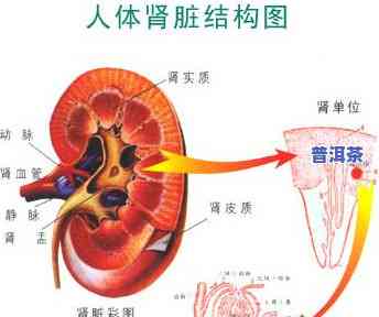 肾结石不能喝茶叶吗-三个动作排出肾结石