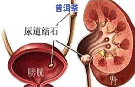 肾结石不能喝茶叶吗-三个动作排出肾结石