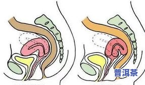 喝普洱茶影响前列腺吗？女性如何正确调理？