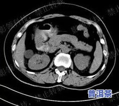 普洱茶胆囊：适合胆囊炎患者饮用吗？探讨其作用