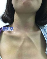 甲状腺癌能喝普洱茶吗-甲状腺癌能喝普洱茶吗女性