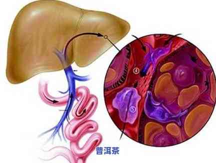 甲状腺疾病能否喝茶叶？详解影响与建议