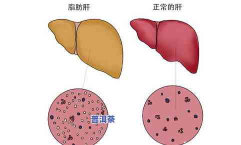 肝不好能否饮用茶叶水？影响因素解析