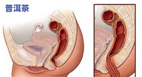 直肠溃疡能喝红茶吗？女性患者需要注意什么？