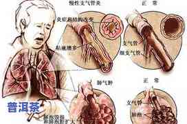 气管炎可以喝普洱茶吗？女性、支气管炎患者适用吗？