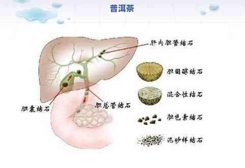 肝上囊肿可以喝普洱茶吗-肝上囊肿可以喝普洱茶吗女性