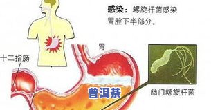 治幽门螺杆菌的茶叶是什么？名称、种类全揭秘！