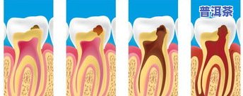 普洱茶治蛀牙有用吗？多少钱一克？对防龋齿、牙疼有何作用及好处？