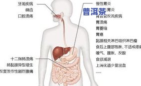 杀幽门螺杆菌的茶叶可以喝吗？女性适用，无副作用