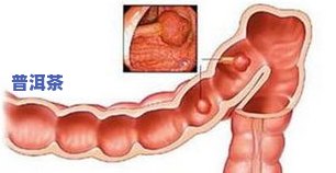 肠息肉能不能喝茶叶-肠息肉能不能喝茶叶水
