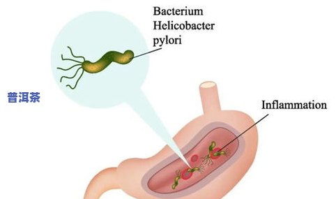 治疗幽门螺杆菌的茶叶，神奇茶叶，轻松治疗幽门螺杆菌！