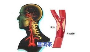 动脉硬化喝茶叶好吗，探讨动脉硬化的治疗：饮用茶叶是否有益？