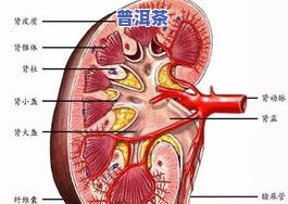 肾盂肾炎能喝普洱茶吗男性，男性肾盂肾炎患者是否适合饮用普洱茶？