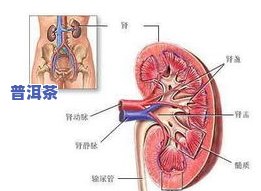 肾结石患者可以喝茶叶茶吗？关于结石与茶水的问题解答