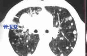 肺癌可以喝茶叶水吗-肺癌可以喝茶叶水吗女性