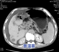 胃癌晚期8年了，怎样治疗？生存期预估？