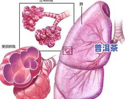 普洱茶对慢性咽喉炎有效果吗？探讨其在治疗中的作用与效果