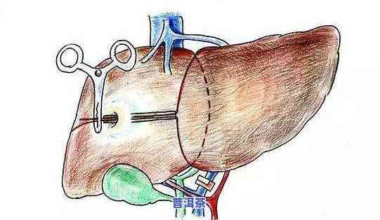 普洱茶肝炎：对肝炎病人有益吗？