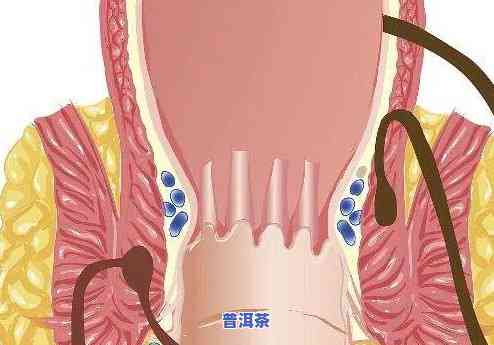 内痔好了可以喝吗，内痔治愈后是不是可以饮？医生解答